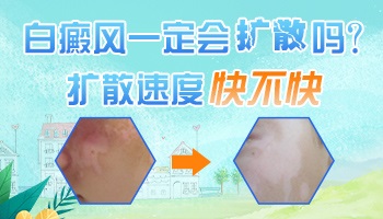 背部晕痣型白斑会发展到脸上吗