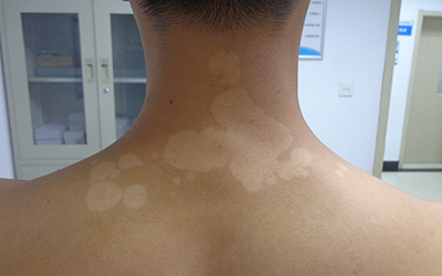背上长白斑是什么病的症状