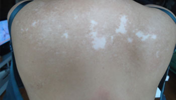 背部白斑早期图片