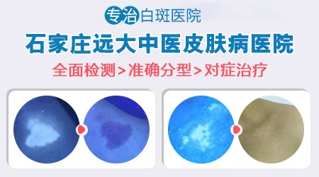 后背白癜风照射家庭版光疗机行不行