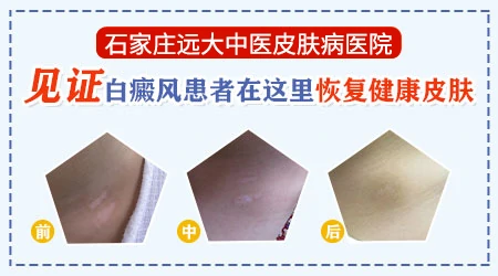 脖子出现白斑怎么办
