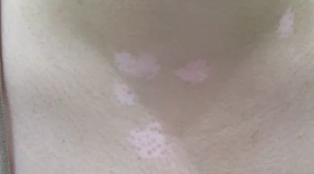 脖子白了一片是什么情况