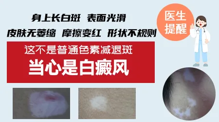 脖子上的浅色白斑块摸起来很光滑没皮屑是什么