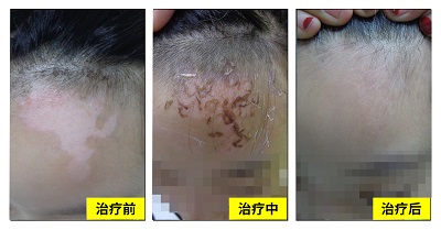 面部白斑植皮手术后恢复图