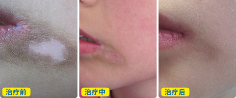 嘴巴周围一圈白的原因是什么