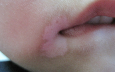 嘴角白斑初期症状图片