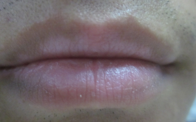 嘴唇白癜风初期症状图片