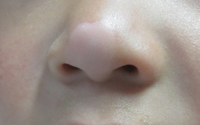 鼻子上的白斑不太明显有小半年了