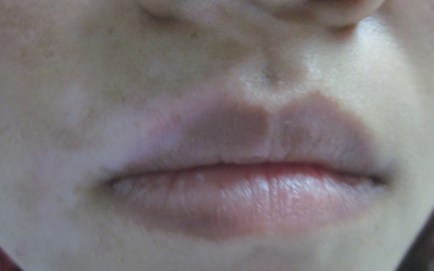 口唇白斑早期症状表现是什么样