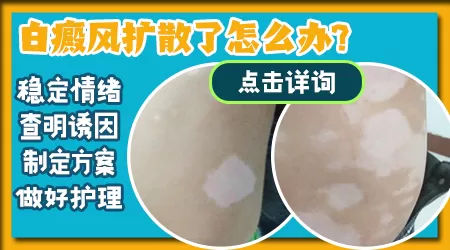 脸上白斑更白了怎么回事