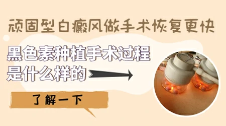 面部白癜风能不能植皮会不会留疤