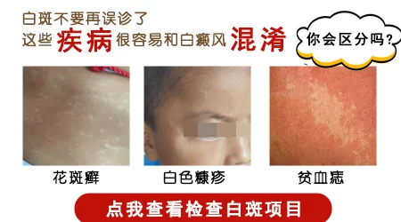 脸上出现一块白怎么看是不是白癜风