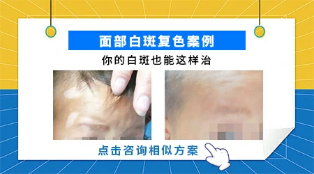 面部白癜风可以做激光治疗吗