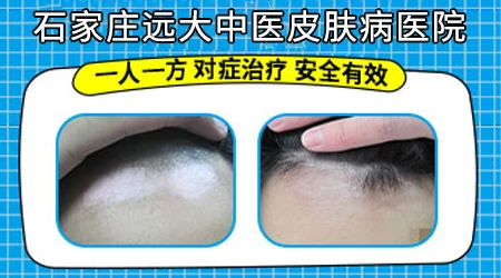 眉毛间出现几点白斑怎么回事