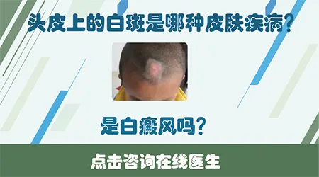 头皮发白图片 头皮白斑是白癜风吗