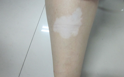 小腿皮肤有一处白色的斑点