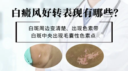小腿外侧白癜风蔓延成一大片了