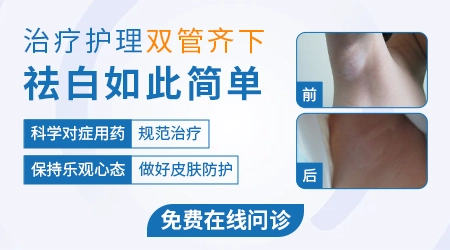 小腿外侧白癜风蔓延成一大片了
