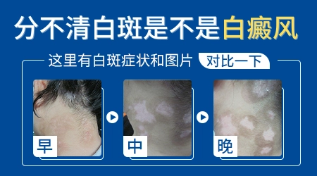 腿上白斑夏天明显冬天变淡是什么