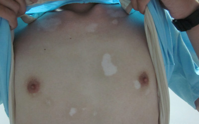 胸部长了几块白斑是怎么回事 引起胸部白斑的原因