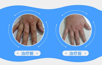 手指关节出现白斑如何辨别是不是白癜风