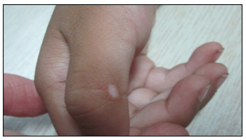 幼儿手上有白色的斑块是什么