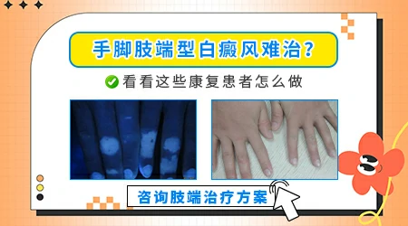 手指上白癜风怎么治有效果