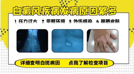 脸上白癜风是什么原因引起