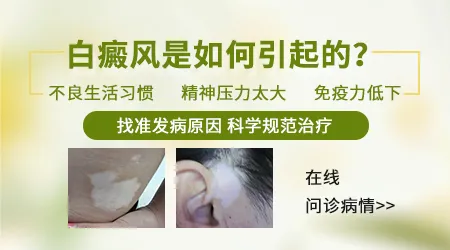 白癜风是怎么引起的 能不能治好