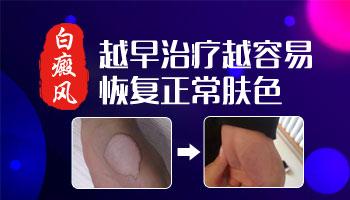 白癜风恢复过程步骤是什么样的