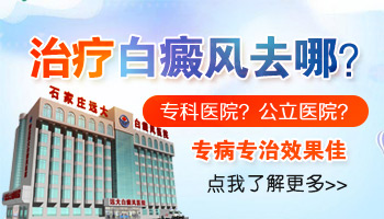 偶尔吸二手烟会对白癜风造成影响么