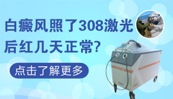 308激光照完白癜风红几天最好