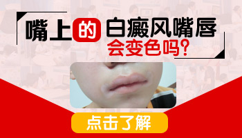 嘴巴上面长白癜风是什么样