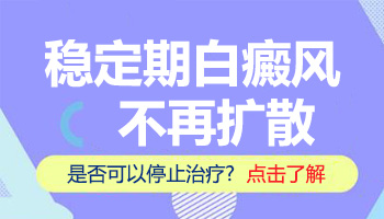 白癜风两年不变大是什么