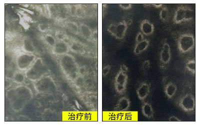 光疗后白斑发红才有效吗 不红就没效果吗