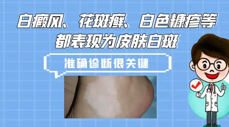 什么样的白斑是正常的 白癜风和普通白斑对照图