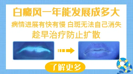 眼角的白斑边缘变得模糊是不是处于发展期