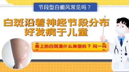 神经节段型白癜风会扩散全身吗