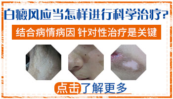 大腿根部白癜风如何治疗效果好