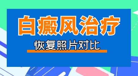 手关节处白癜风照308激光照不红怎么办