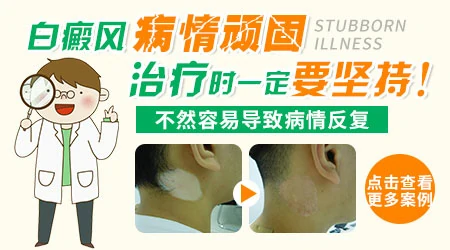手指白癜风恢复情况