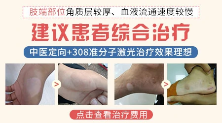 小腿部位的顽固性白癜风光疗能治好吗