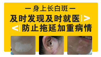 婴儿大腿内侧白斑图片