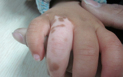 小孩手指上有白斑是怎么回事