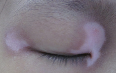 孩子眼角上有块白斑是什么病