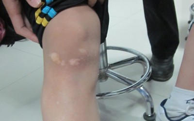 小孩膝盖边上有许多小白点是什么回事