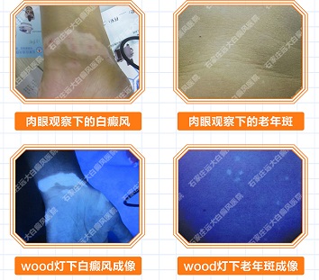 白斑怎么引起的 小孩嘴巴周围皮肤有点发白