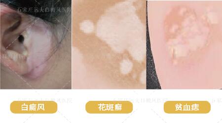 孩子脸上有白色的斑块是白癜风吗