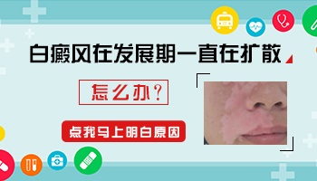 小孩腿上腰上白癜风最近扩散比较快