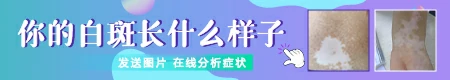 小孩脸上长白块 白斑图